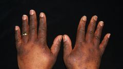 Staying close to a major road can cause eczema [Nationaleczemaassociation)