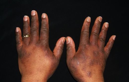 Staying close to a major road can cause eczema [Nationaleczemaassociation)