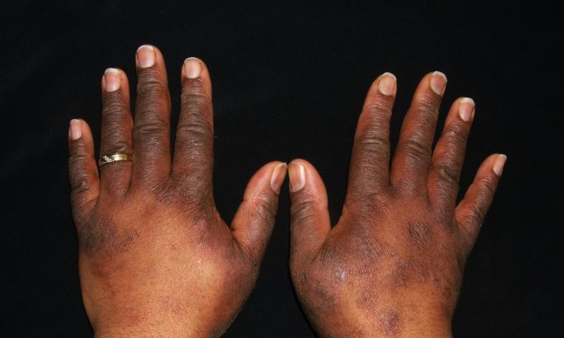 Staying close to a major road can cause eczema [Nationaleczemaassociation)