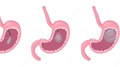 Endoscopic insertion of gastric balloon at Nairobi Bariatric Center
