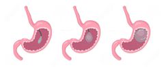 Endoscopic insertion of gastric balloon at Nairobi Bariatric Center