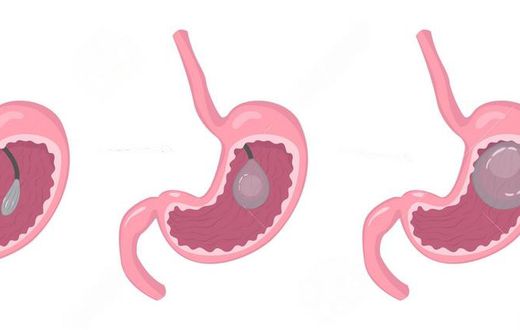 Endoscopic insertion of gastric balloon at Nairobi Bariatric Center