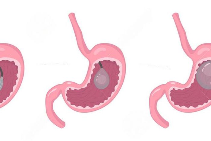 Endoscopic insertion of gastric balloon at Nairobi Bariatric Center
