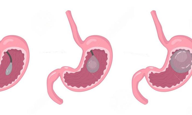 Endoscopic insertion of gastric balloon at Nairobi Bariatric Center