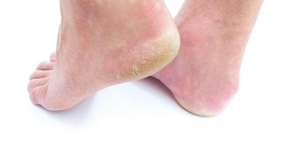 Cracked heels