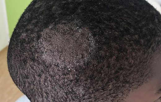 Scalp ringworm