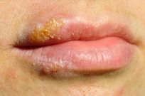 lips with herpes sore [healthboard]