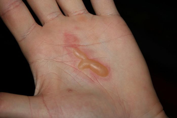 A palm with blisters