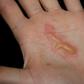 A palm with blisters