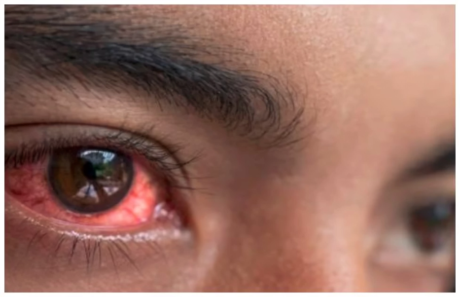 Redeyes