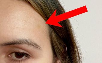 I got a few small bruises on my forehead after my Botox injections. Julia Pugachevsky