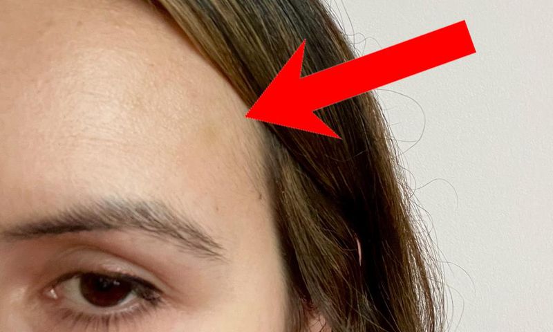 I got a few small bruises on my forehead after my Botox injections. Julia Pugachevsky