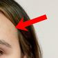 I got a few small bruises on my forehead after my Botox injections. Julia Pugachevsky