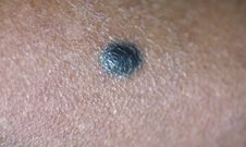 Mole [blackdoctororg]