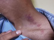 A person affected by Nairobi fly