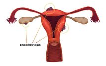 Endometriosis illustration(HealthDirect)