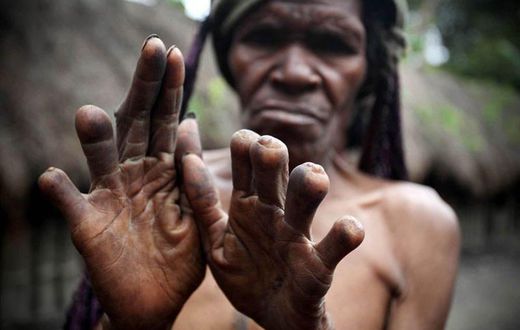 The finger-cutting as a mourning practice of the Dani People [Guardian]
