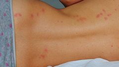 Why is mosquito attracted to you? [Pinterest]