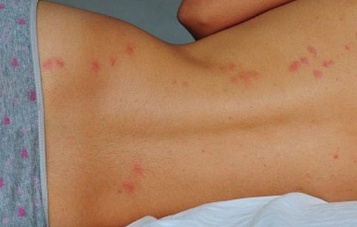 Why is mosquito attracted to you? [Pinterest]