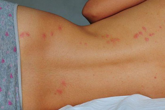 Why is mosquito attracted to you? [Pinterest]