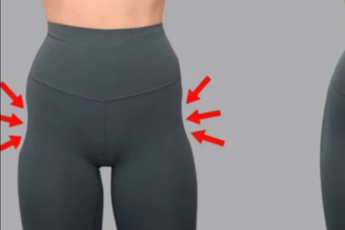 Hip dips are normal, but can they be gotten rid of? [Freepik]