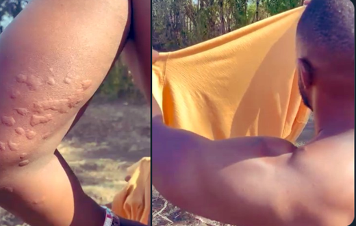 John Allan-Namu after being bitten by bedbugs