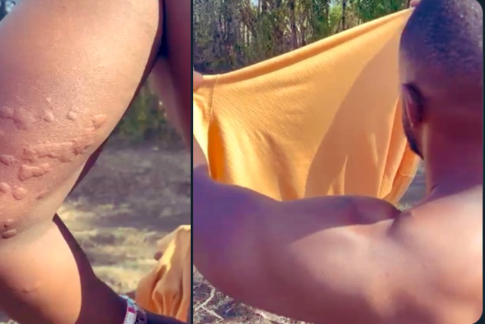 John Allan-Namu after being bitten by bedbugs