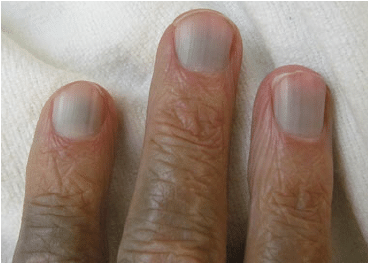 Bluish nails [researchgate]