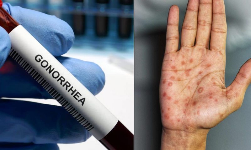 Gonorrhea