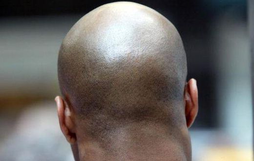 Baldness