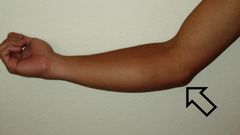 Injured elbow