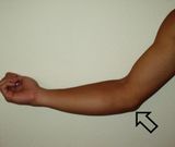 Injured elbow