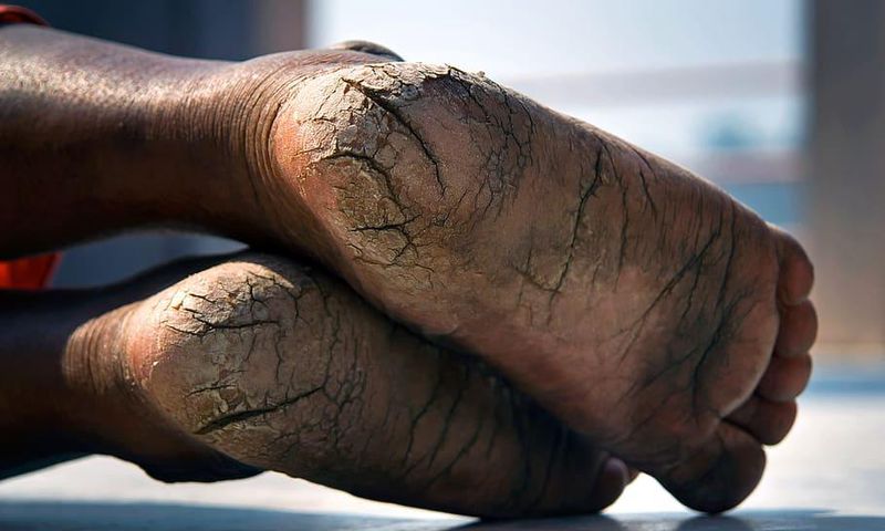 Cracked heels
