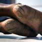 Cracked heels