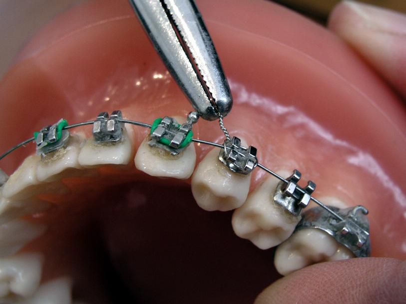 Teeth Braces
