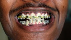 Teeth Braces