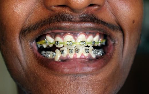 Teeth Braces