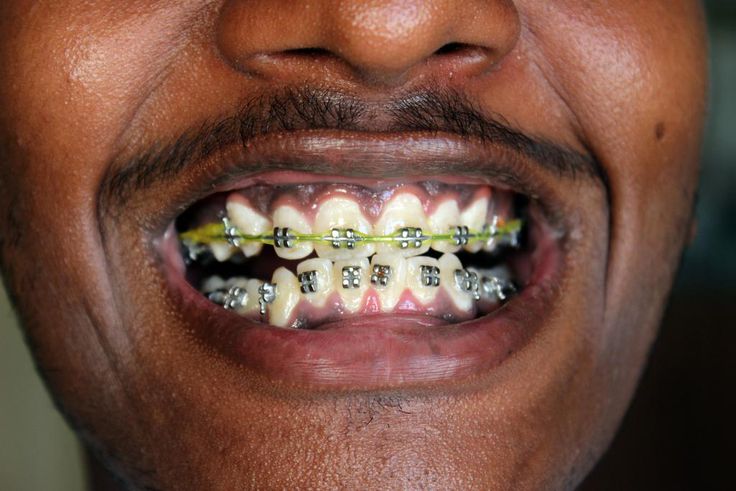 Teeth Braces