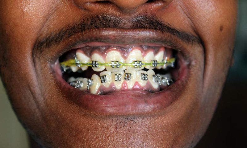 Teeth Braces