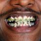 Teeth Braces