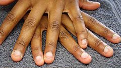 Effects of nail-biting