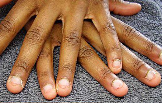 Effects of nail-biting
