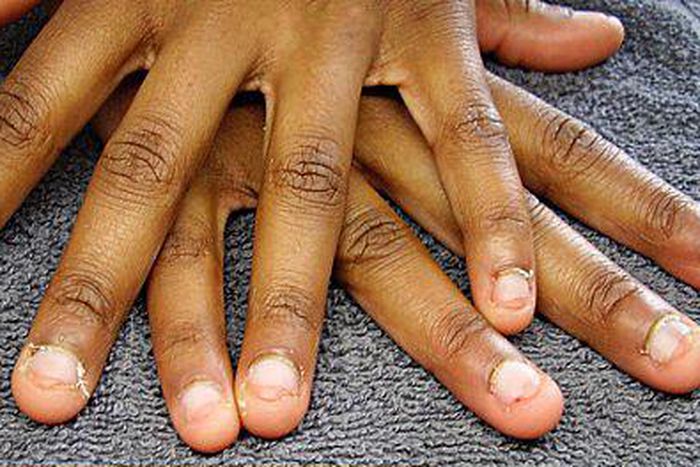 Stop nail biting (Today Newspaper)