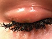Inadequate hygiene practices during the extension process can increase the risk of infection [thepmfajournal]
